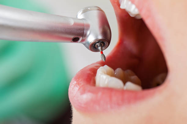 Best Emergency Tooth Extraction in Denton, MD